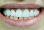 Лікування зубів і відновлення за допомогою керамічних коронок