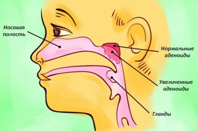 Что такое аденоиды и как с ними бороться при их воспалении