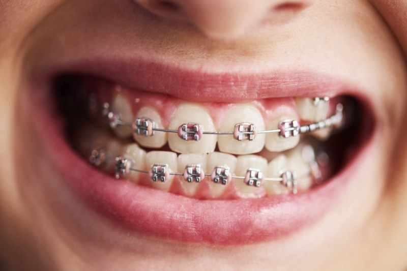 Встановлення брекетів у Києві - сучасні методики