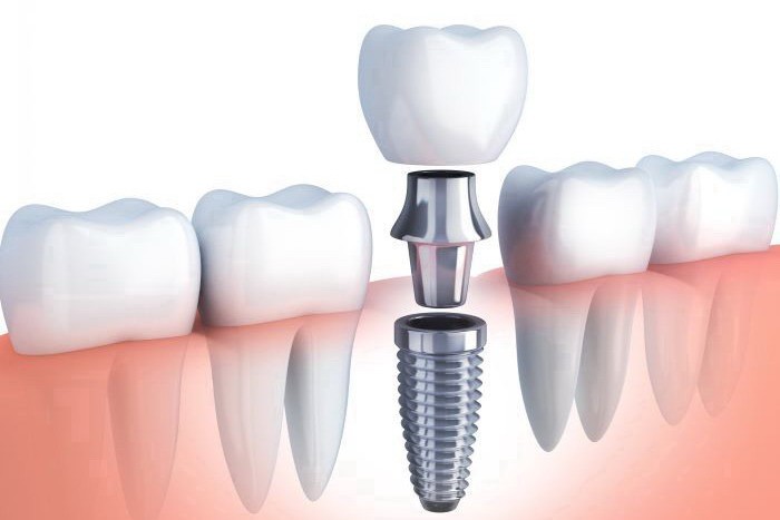 Зубные импланты Штрауман и их преимущества
