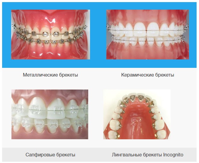 Виды брекет-систем, фото с сайта oxford-med.com.ua