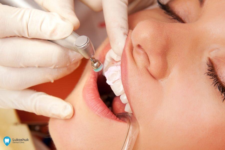 Реставрация зубов с помощью виниров в клинике Лукашука